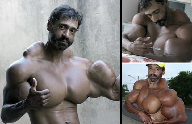 Un homme s’injecte de l’huile dans les muscles pour ressembler à  Arnold Schwarzenegger