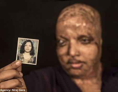 Inde-émouvant: Défigurée et aveuglée à l'acide, elle trouve l'amour à l’hôpital