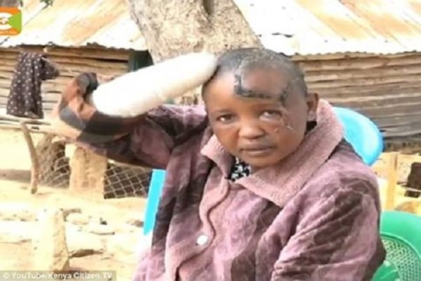 Kenya/Violences conjugales: Elle se fait couper les deux mains par son mari (PHOTO)