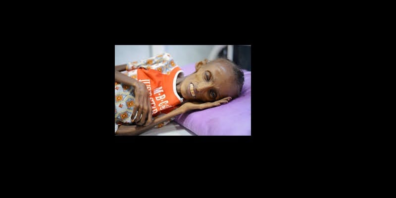 Famine au Yémen : Saïda Baghili avec le visage décharné de la malnutrition