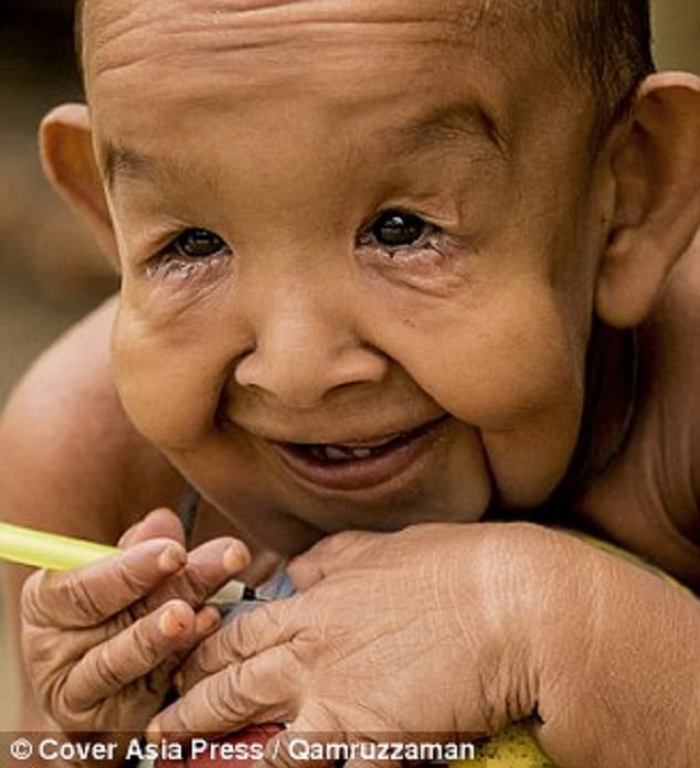 Cet enfant de 5 ans vieillit plus vite qu'un homme normal et pourrait mourir à 13 ans…Les raisons ! PHOTOS