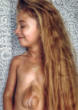 A 6 ans, elle vit avec le cœur hors de la poitrine