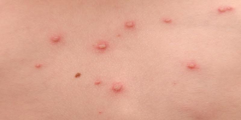 Chickenpox on the back of the child.