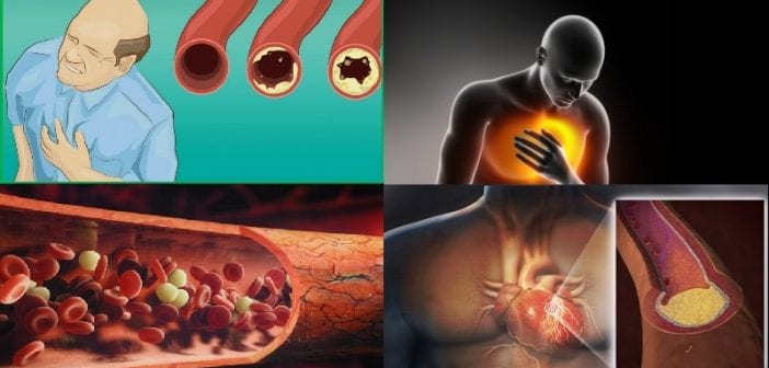 Quels Sont Les Symptomes D Une Artère Bouchée
