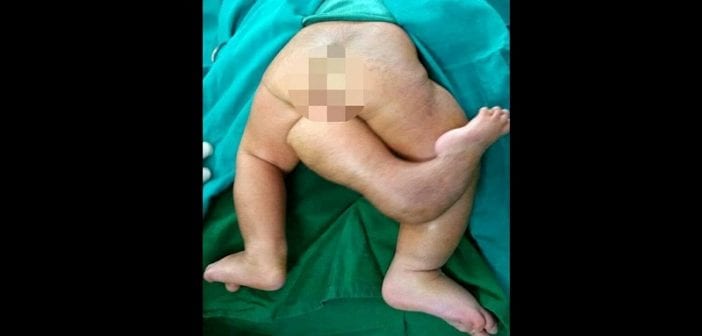 Santé : un bébé naît avec trois jambes...Explications