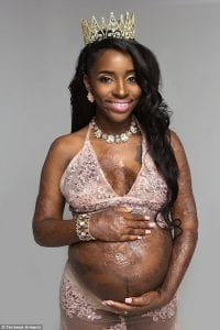 La ''grande brûlée''partage les photos de sa grossesse miraculeuse