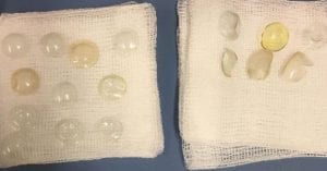 Royaume-Uni: une femme vivait avec 27 lentilles coincées dans les yeux