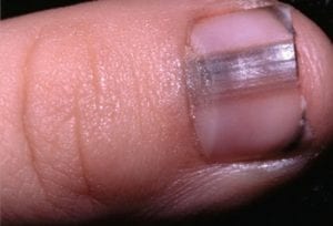Voici 10 changements sur vos ongles qui pourraient cacher des problèmes de santé