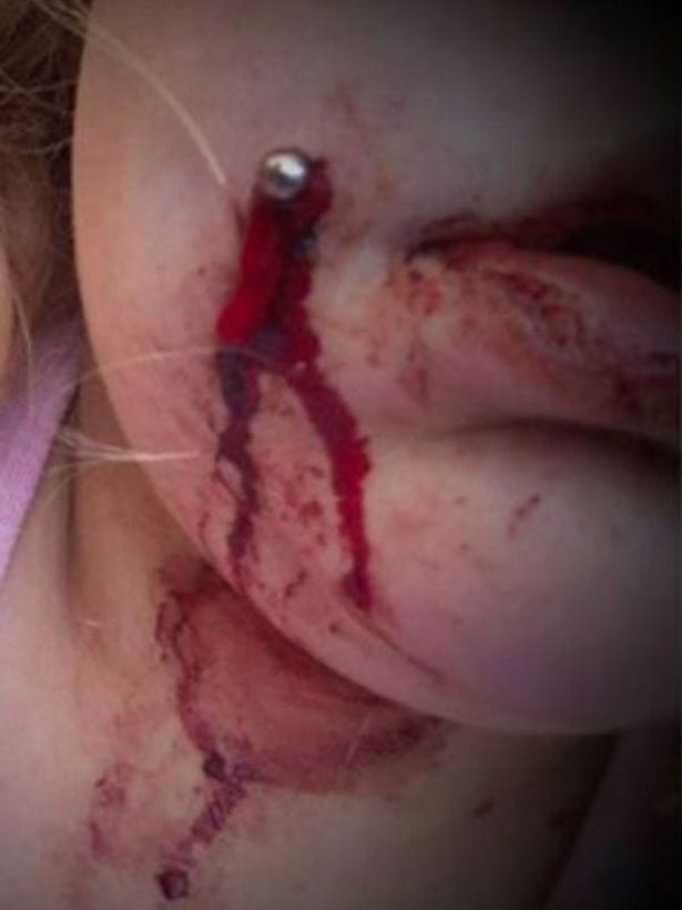 Un perçage pour des fossettes laisse une adolescente dans un état horrible (photos)