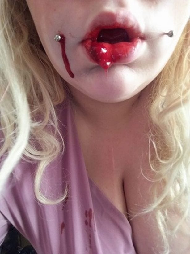 Un perçage pour des fossettes laisse une adolescente dans un état horrible (photos)