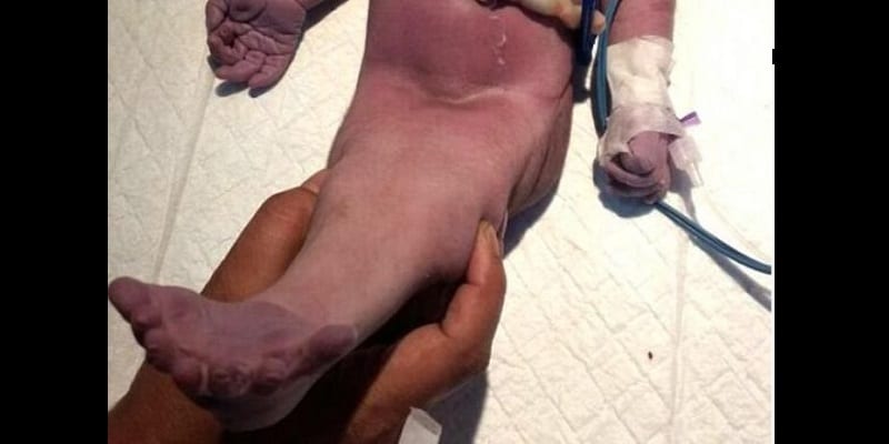 Inde-insolite : une maman donne naissance à un « bébé sirène » (photos)