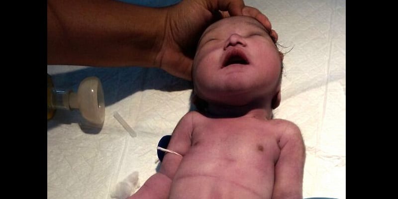 Inde-insolite : une maman donne naissance à un « bébé sirène » (photos)