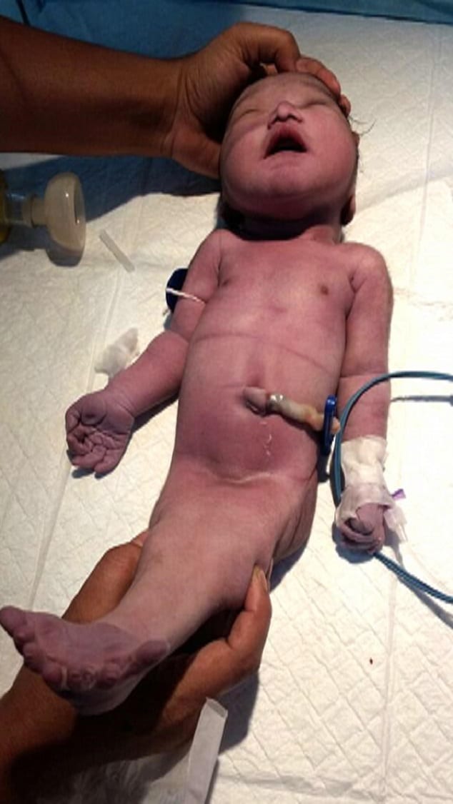 Inde-insolite : une maman donne naissance à un « bébé sirène » (photos)