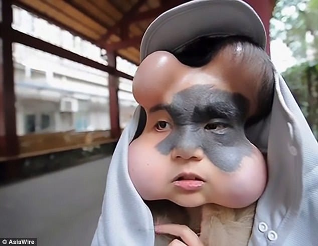 Chine: 4 ballons implantés dans le visage d'une femme pour sauver sa vie