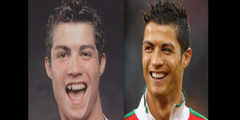 Découvrez ces célébrités du football qui ont refait leur dentition (photos)