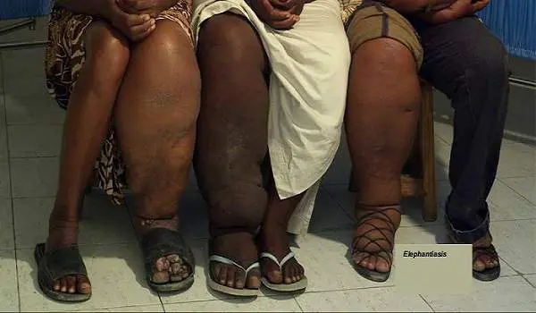 elephantiasis