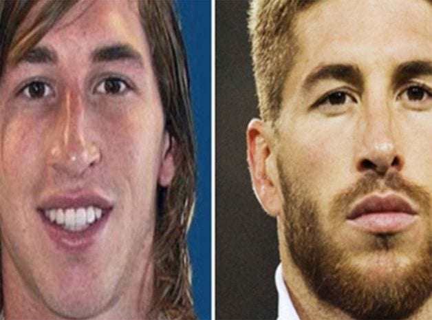 Football: Quelques joueurs qui ont fait recours à la chirurgie esthétique
