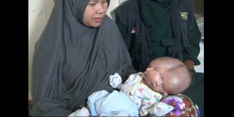 Indonésie : Un bébé naît avec deux visages, deux cerveaux et une seule tête (vidéo)