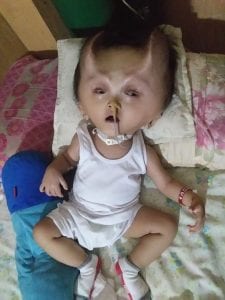 Insolite : Un bébé développe des « cornes » après une opération chirurgicale (photos)