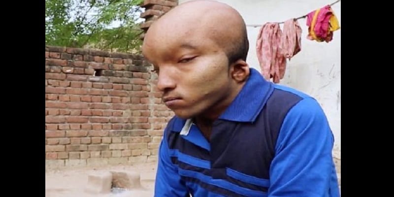 indian1 - Inde : Un homme à la tête « d’alien » recherche l’amour (photos)