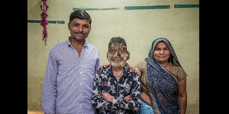 IndeÂ : DÃ©couvrez Lalit Patidar, le garÃ§on de 13 ans atteint du Â«Â syndrome du loup-garouÂ Â» (photos)