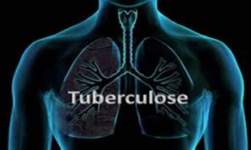 tuberculose-clichet-280318-800px