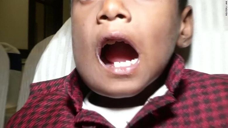 Inde : des médecins découvrent 526 dents dans la bouche d'un garçon de 7 ans (vidéo)