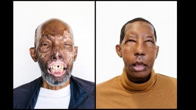 face-transplant-african-american-2-1