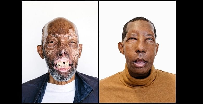 face-transplant-african-american-2-1