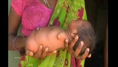 baby-born-no-arms-legs-limbs-india-903938