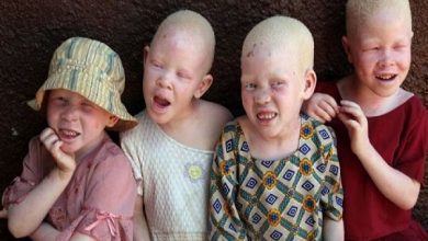 Albinos-in-Malawi-6x52pr43u7nz7kc0vywgqsf136vdc5dm1irkxac8oqo
