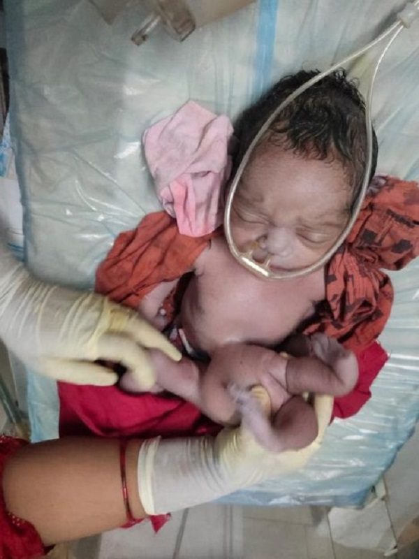 Un bébé né avec 4 bras et 4 jambes salué comme un "miracle de la nature"