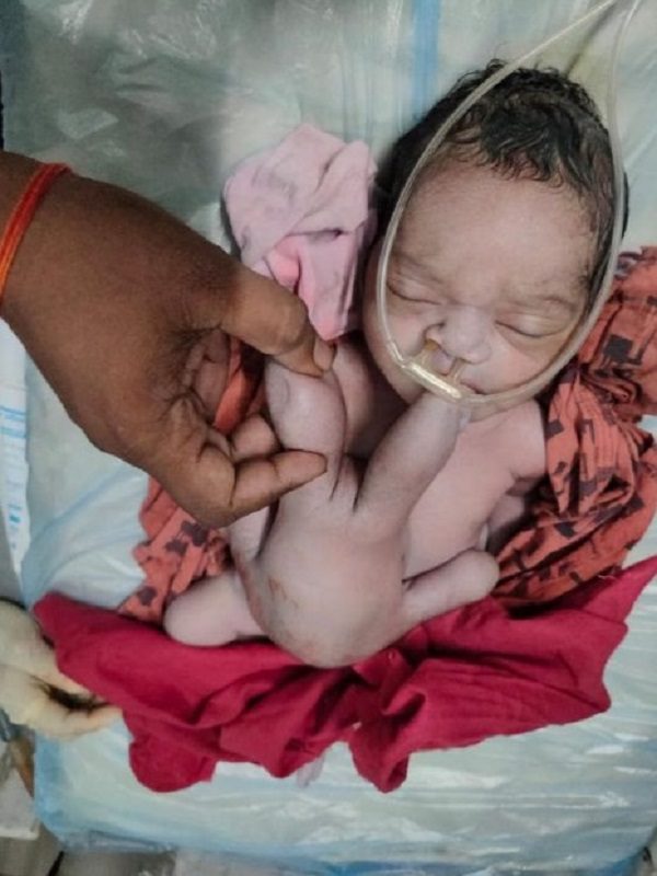 Un bébé né avec 4 bras et 4 jambes salué comme un "miracle de la nature"