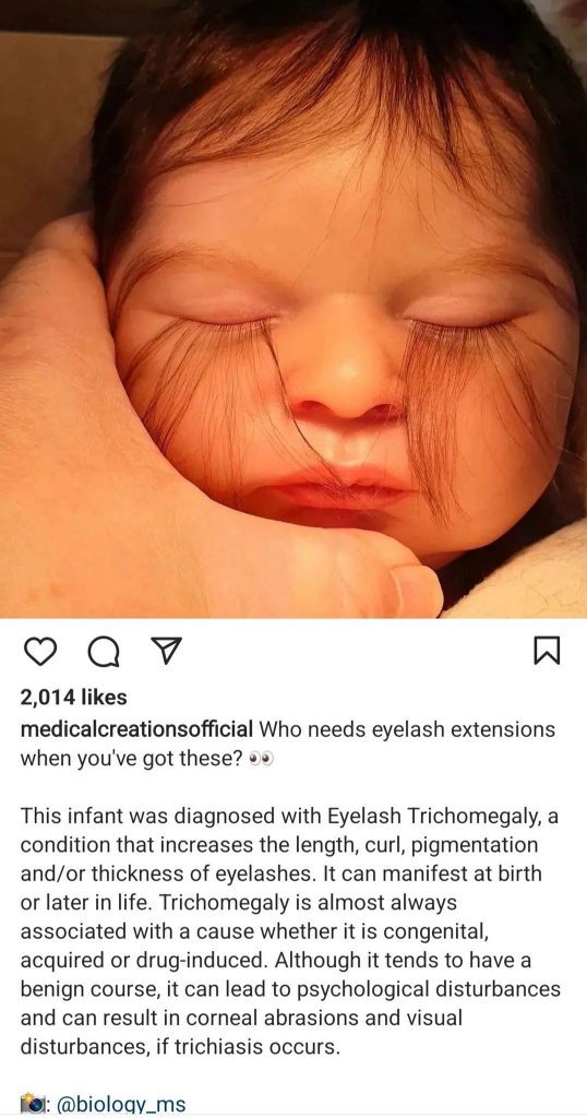Un bébé né avec des cils très longs diagnostiqué de trichomégalie des cils