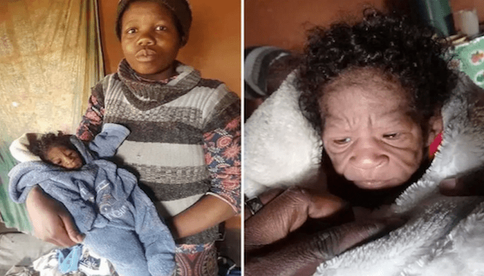 une mère sud-africaine et son bébé atteint de progeria