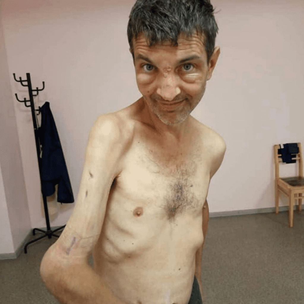 Photos choquantes d'un soldat ukrainien avant et après sa captivité en Russie