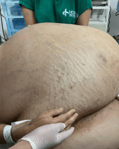 Brésil : une femme s’est fait retirer une tumeur de 45 kg (photos)
