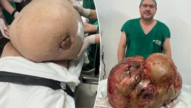 surgeon-removes-98-pound-tumor-comp