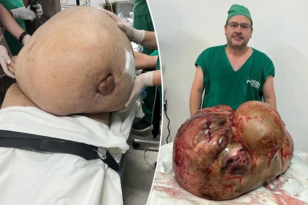 surgeon-removes-98-pound-tumor-comp