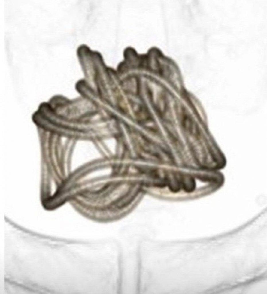 Une corde à sauter coincée dans la vessie d’un homme de 79 ans après l'avoir insérée par son p3nis