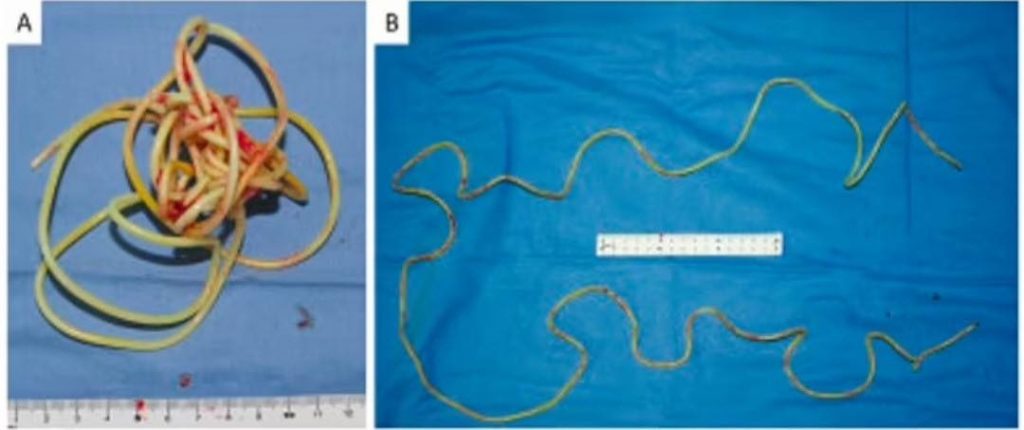 Une corde à sauter coincée dans la vessie d’un homme de 79 ans après l'avoir insérée par son p3nis