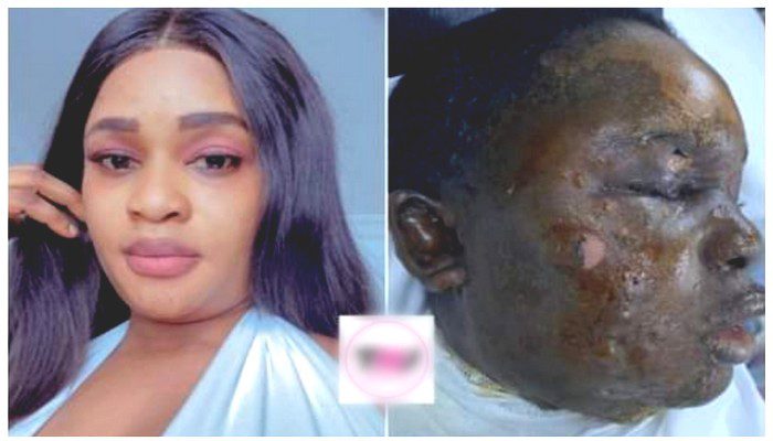 Une camerounaise aurait versé de l’huile chaude sur le visage de son collègue après une bagarre à Chypre