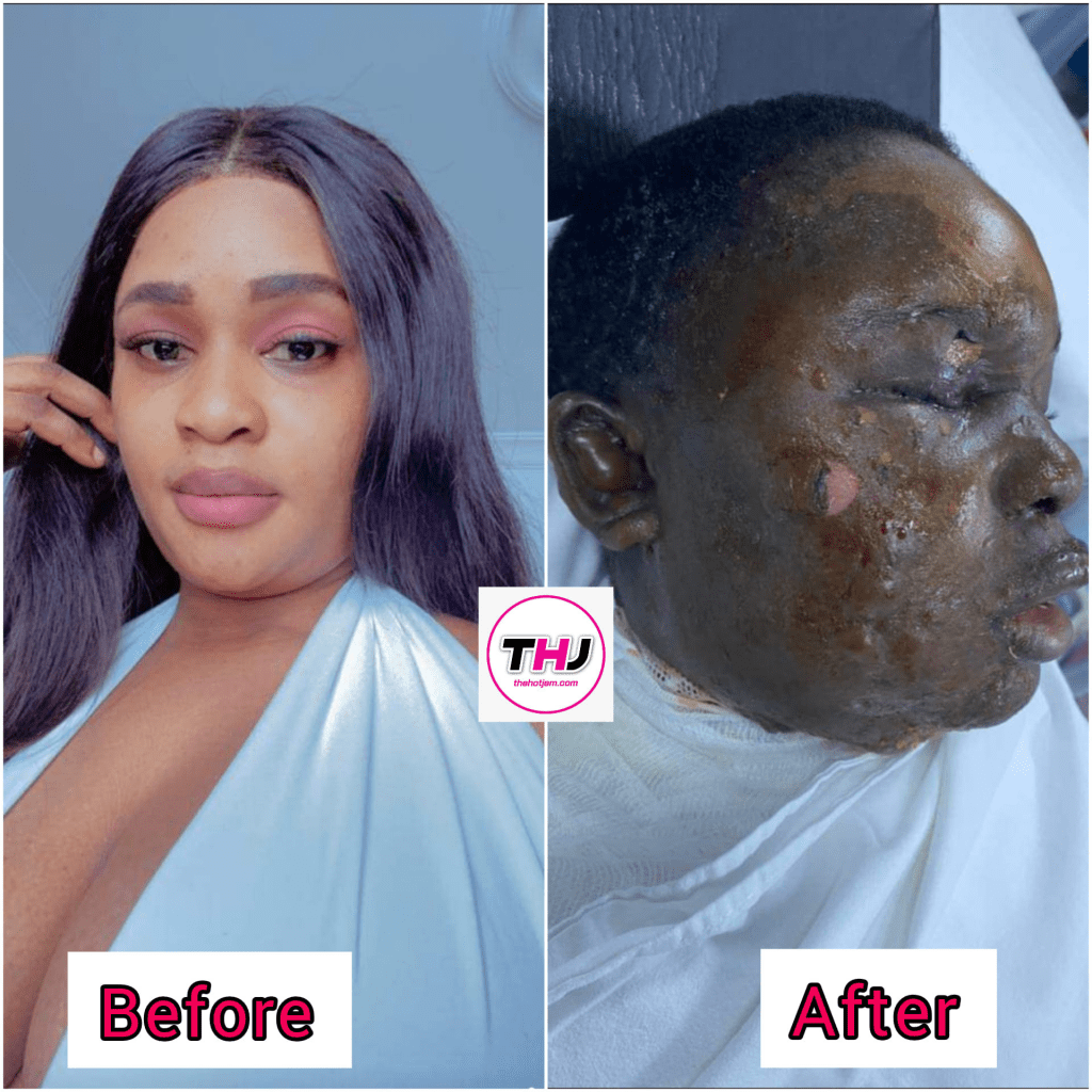 Une Camerounaise aurait versé de l'huile chaude sur le visage de sa collègue