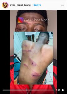 Cameroun / Un homme battu à sang parce que qualifié d'homos3xuel
