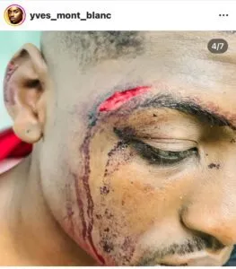 Cameroun / Un homme battu à sang parce que qualifié d'homos3xuel