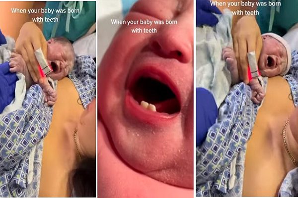 Une femme donne naissance à un bébé avec des dents