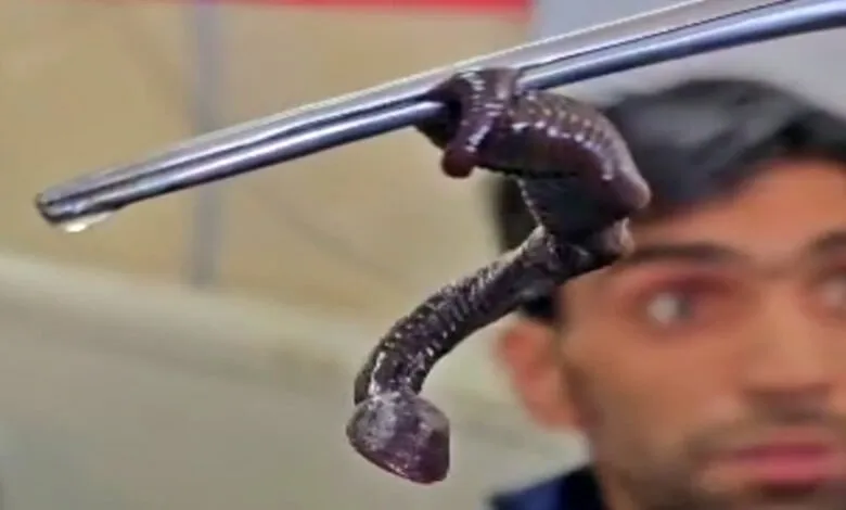 un vers ressemblant à un serpent retiré du nez d’un garçon de 9 ans