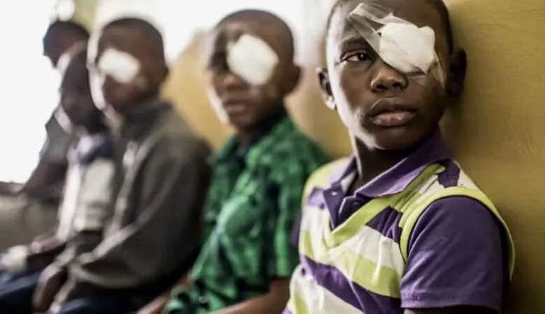 Santé-le-Sénégal-surmonte-un-problème-vieux-de-plusieurs-siècles-le-Trachome