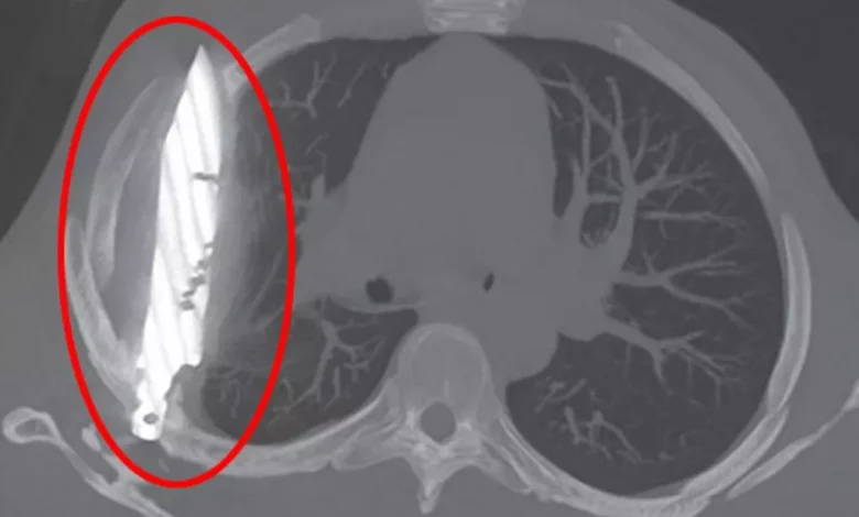 Les médecins découvrent un grand couteau logé dans la poitrine d’un homme depuis huit ans