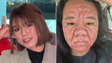 Une-femme-révèle-comment-les-hormones-de-grossesse-ont-rendu-son-visage-méconnaissable